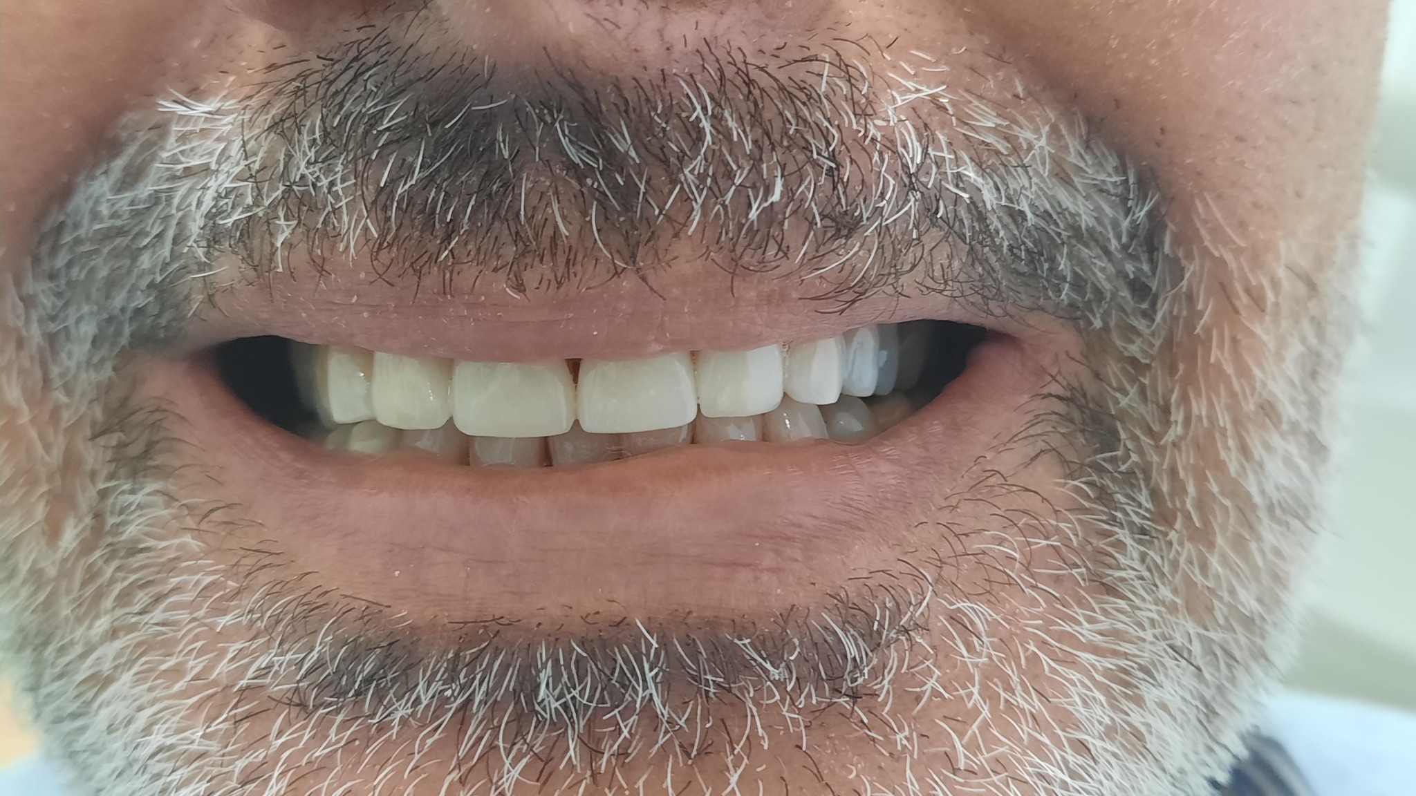 Dopo il trattamento - Sorriso perfetto