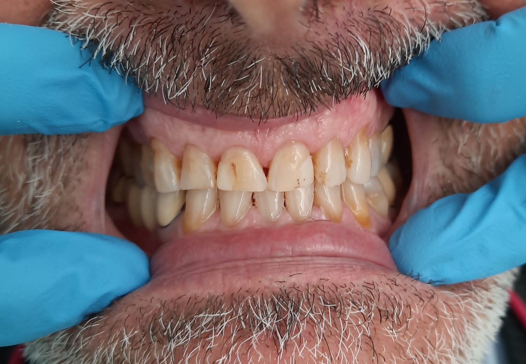 Prima del trattamento - Denti da riparare