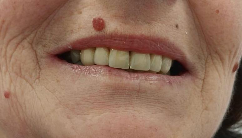 Dopo il trattamento - Sorriso perfetto