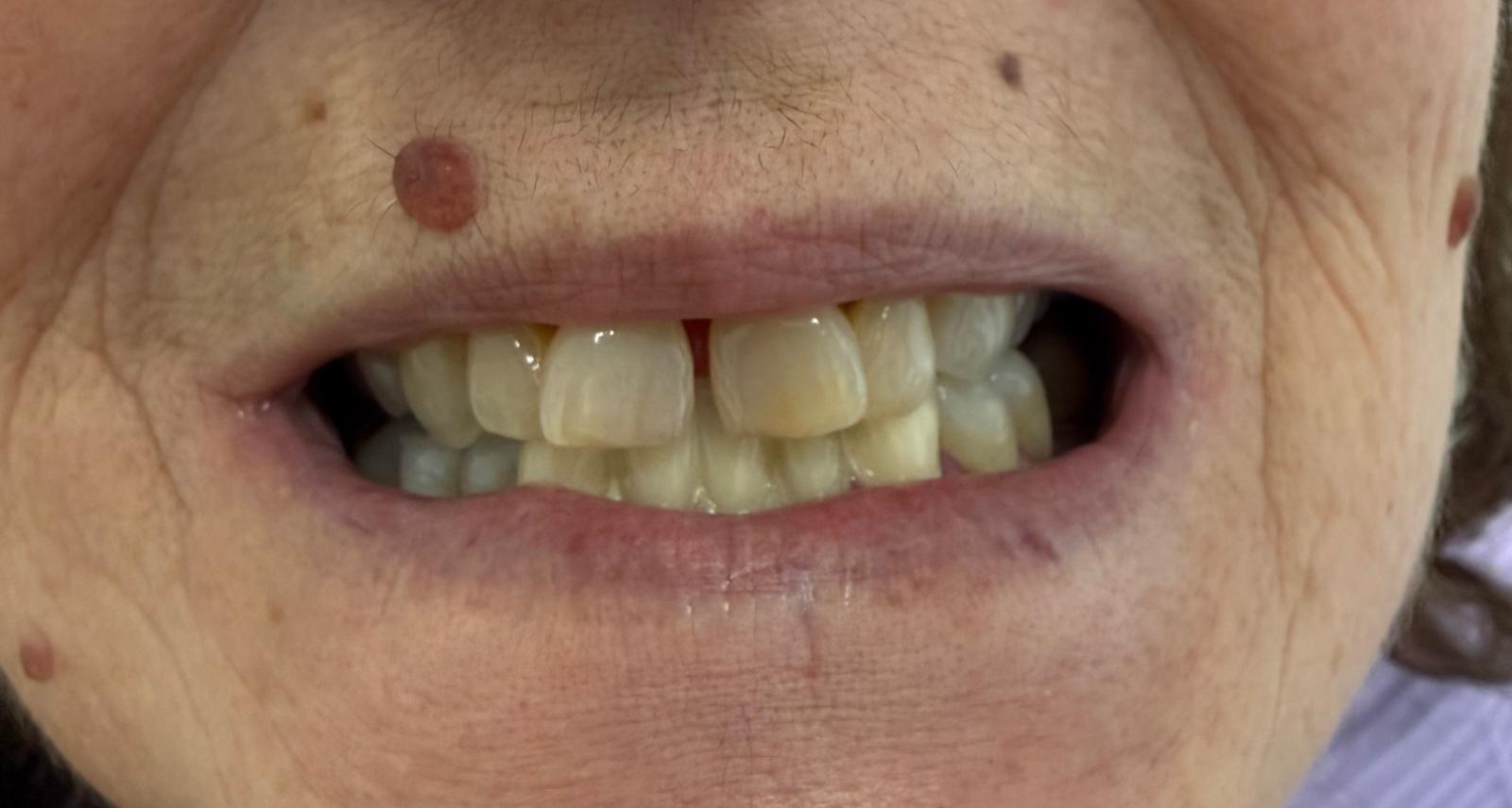 Prima del trattamento - Denti da riparare